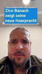 Zico Banach zeigt nach Transplantation seine neue Haarpracht