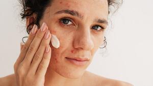 Produkte mit Azelainsäure können Akne effektiv bekämpfen.