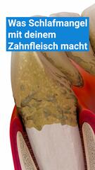 Das macht Schlafmangel mit deinem Zahnfleisch