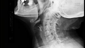 Röntgenbild: Nagel steckt im Hals fest