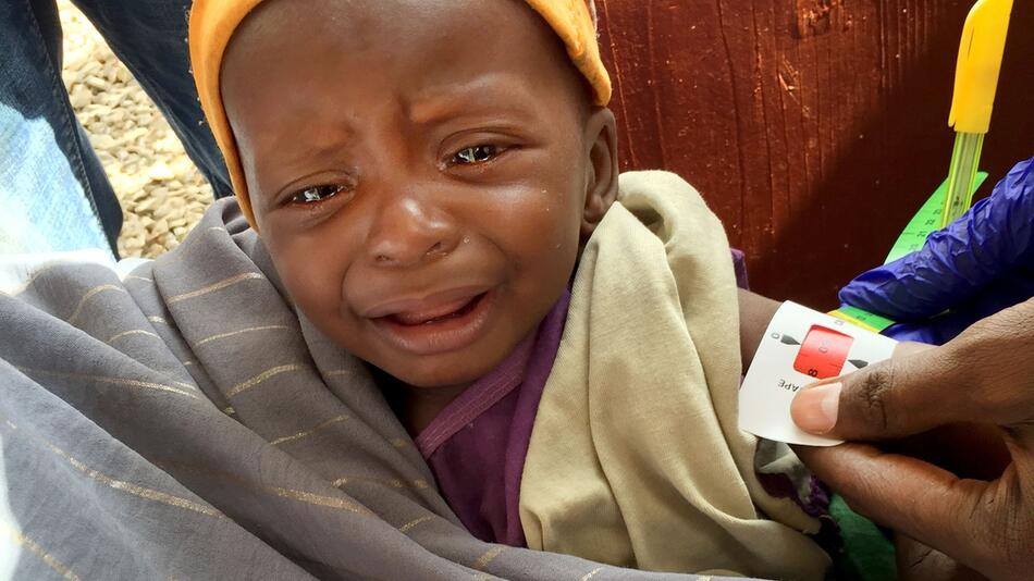 Unterernährtes Baby in Somalia