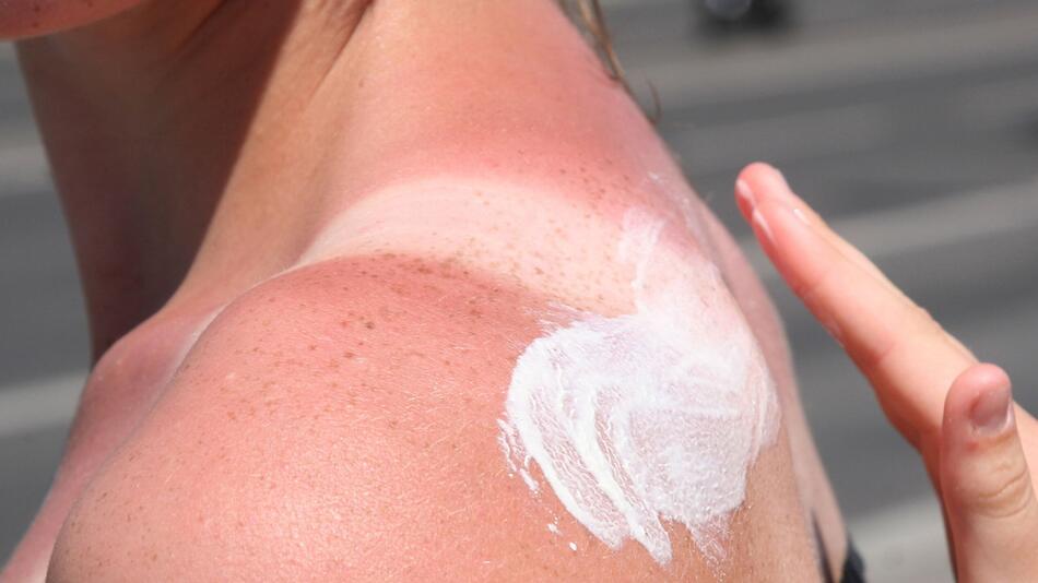 Eine Frau trägt Creme auf einen Sonnenbrand auf