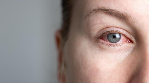 Frau mit gerötetem Auge