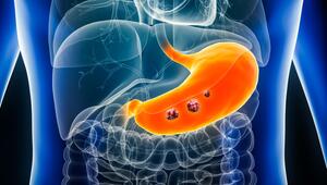 Illustration vom Magen mit Tumor