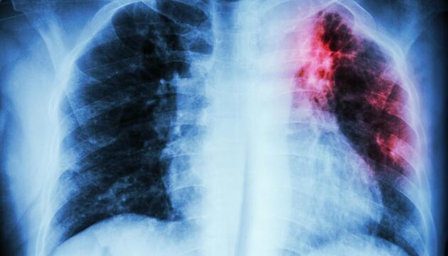Röntgenbild eines Brustkorbes mit farblich hervorgehobenem Bereich